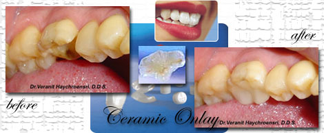 Ceramic/porcelain inlays&onlays:Phuket dental clinic,Thailand